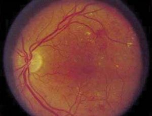1. ábra Nonproliferativ diabéteszes retinopátia. Mikroaneurizmák, kevés pontszerű és tócsás vérzések a retinában, sárga foltokként előtűnő kemény exszudátumok láthatók.
