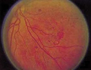 2. ábra Érújdonképződés a retina síkjában a középperifériás retinán („csodarece” forma).