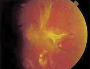 3. ábra A fibrovaszkuláris proliferáció kötegei sátorszerűen elemelik a retinát alapjáról (tractiós ablatio retinae).
