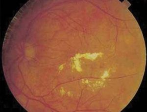 4. ábra Klinikailag szignifikáns makula ödéma, ami a gyűrű formájú, sárga kemény exszudációs gócok által határolt területet érinti. A képen a makula ödéma csak valószínűsíthető, a megvastagodott retinát binokuláris oftalmoszkópiával, FLAG vagy OCT vizsgálattal lehet biztosan felismerni