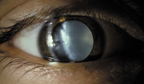 Glaukóma - népi kezelés - a szem glaukóma tünetei
