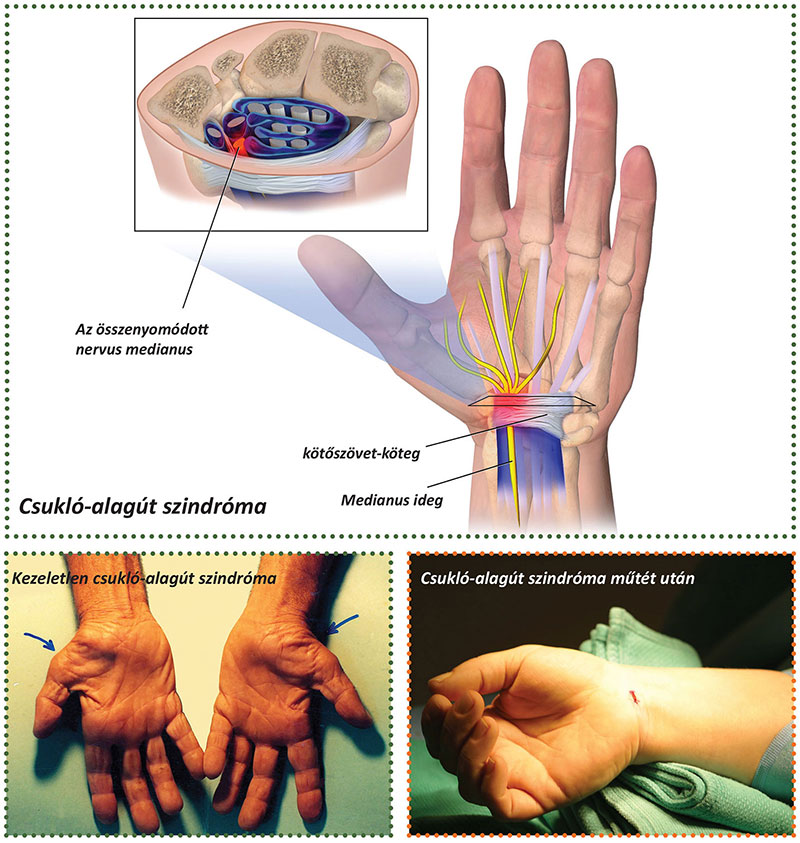 Mi a teendő, ha az ujjak ízületei fájnak: az okok és a kezelés