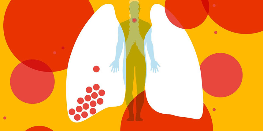 COVID-19 rizikófaktorai - idős, asztmás és cukorbeteg férfiak