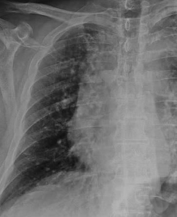röntgenfelvétel egy beteg tüdejéről
