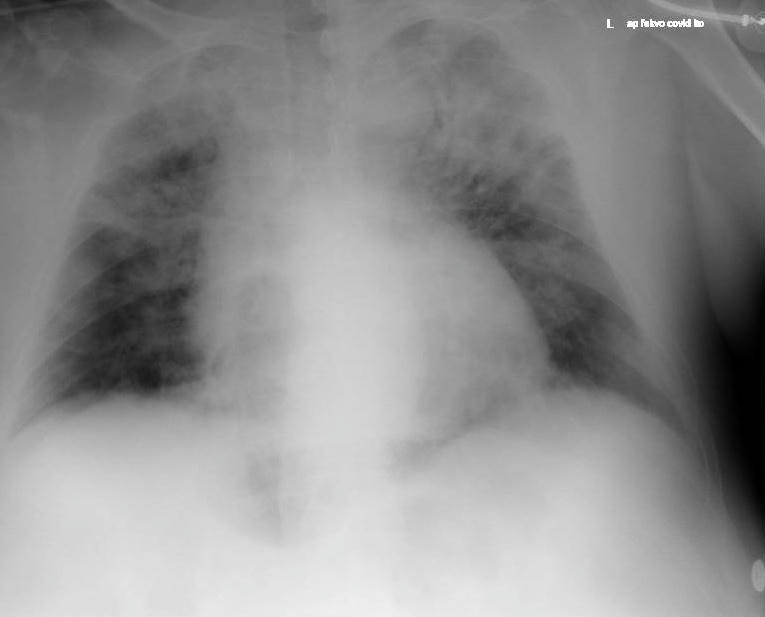 légzési nehézség COVID tüdőgyulladás